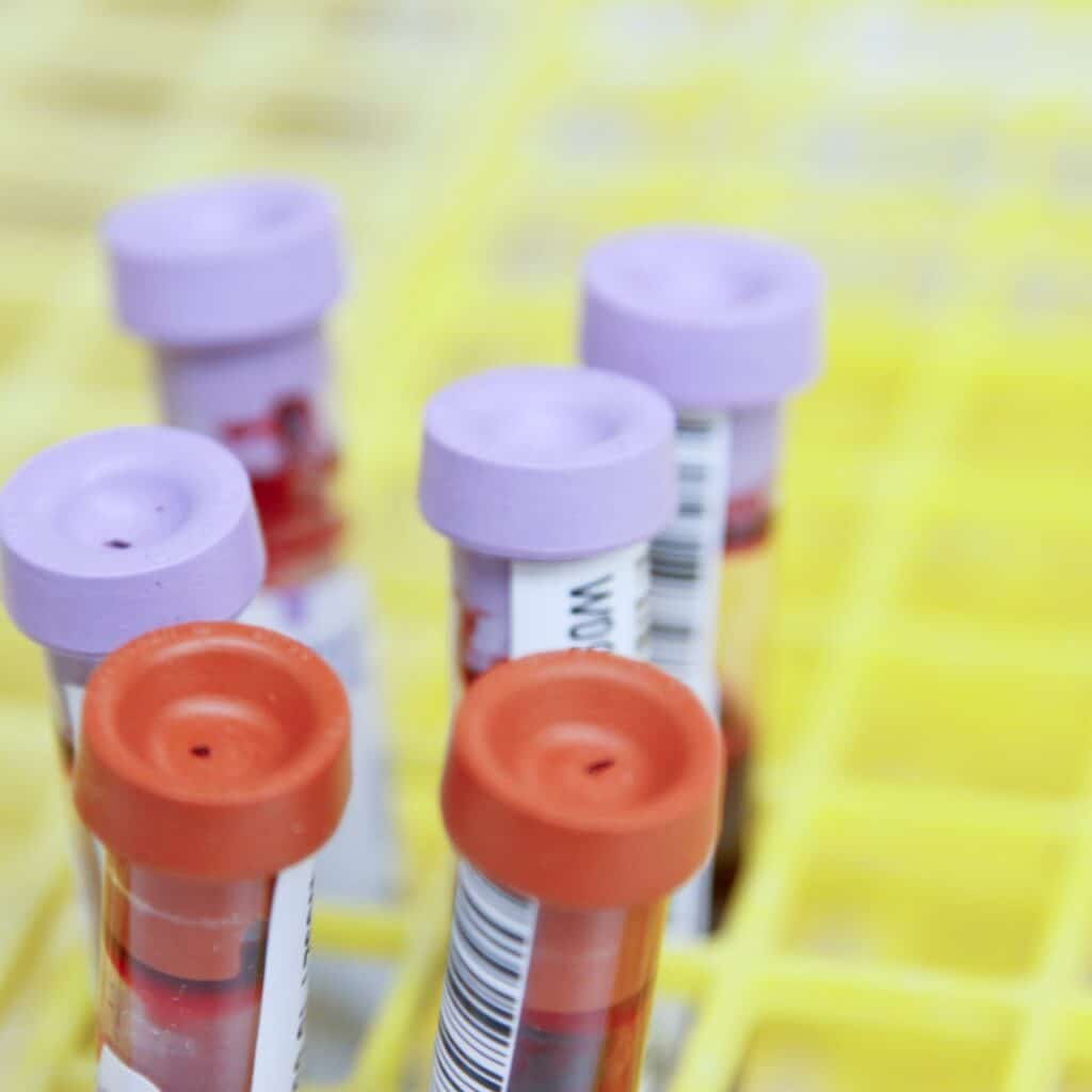 vials from blood test